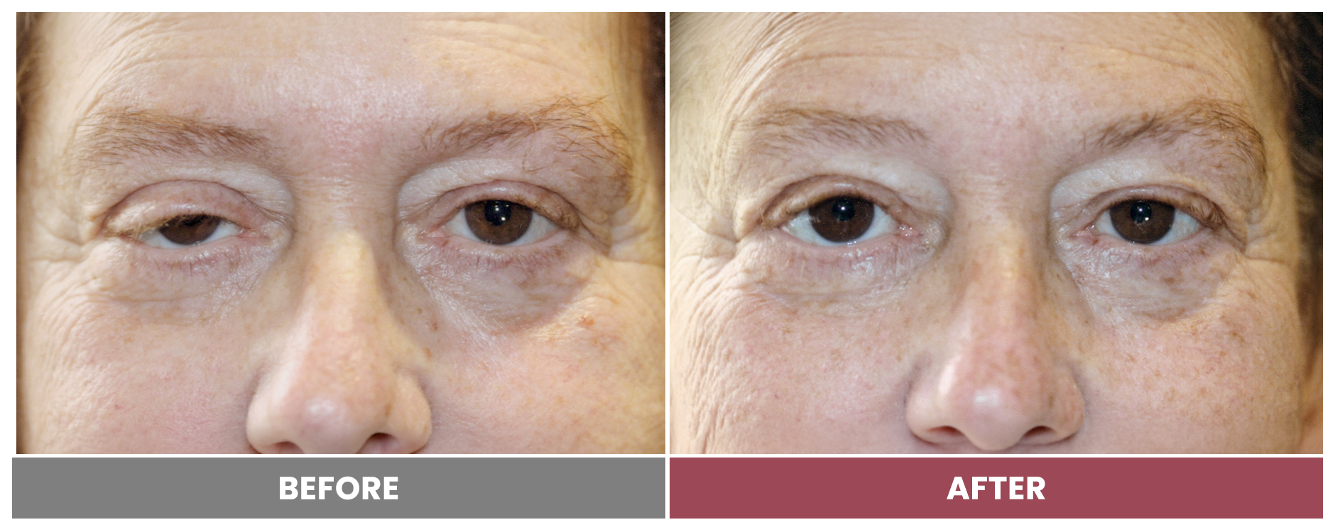 PTOSIS REPAIR - Case 51